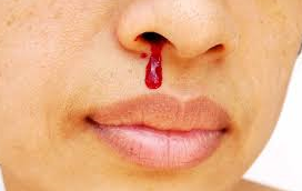 CÎND ÎȚI CURGE BULIONUL / ORICARE AR FI SEZONUL – ADICĂ DESPRE CAUZE SÂNGERĂRI NAZALE