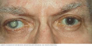 CATARACTĂ POZE