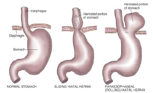 despre hernia hiatala