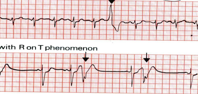 INTERPRETAREA UNEI ELECTROCARDIOGRAME