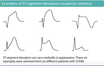 ELECTROCARDIOGRAMA DIN INFARCT