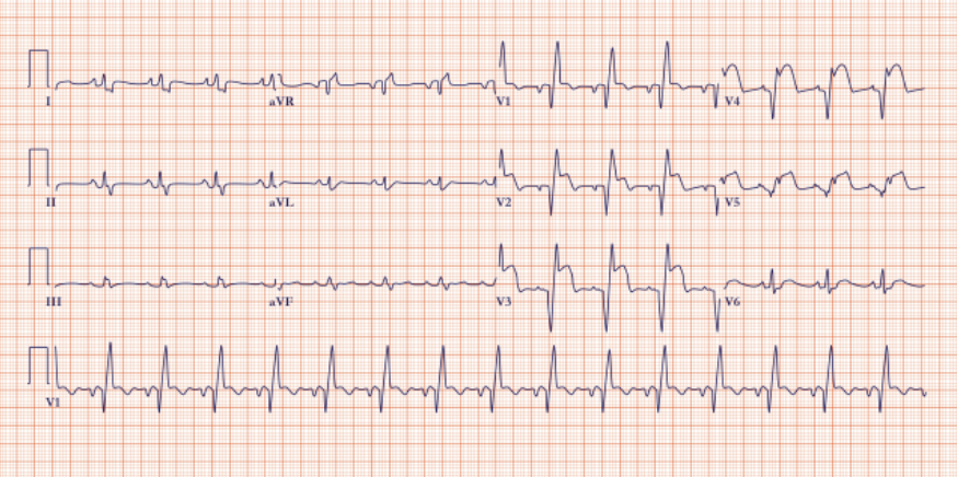 ELECTROCARDIOGRAMA DIN INFARCT