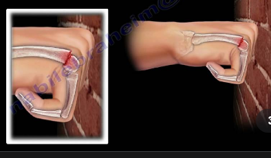 DÎND CU PUMNUL … PRIN CASĂ – FRACTURA BOXERULUI