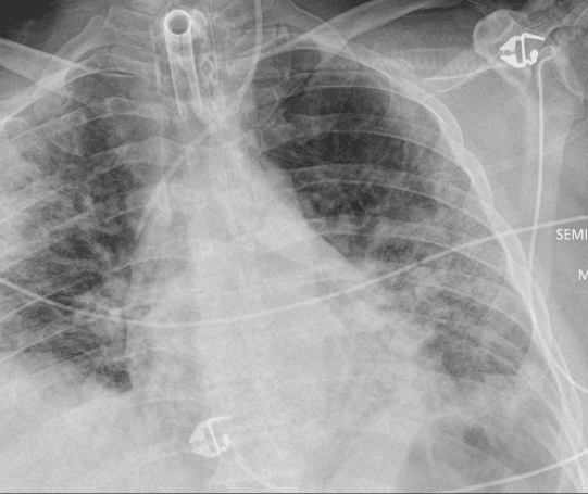 INTERPRETARE RADIOGRAFIE PULMONARA - COVID