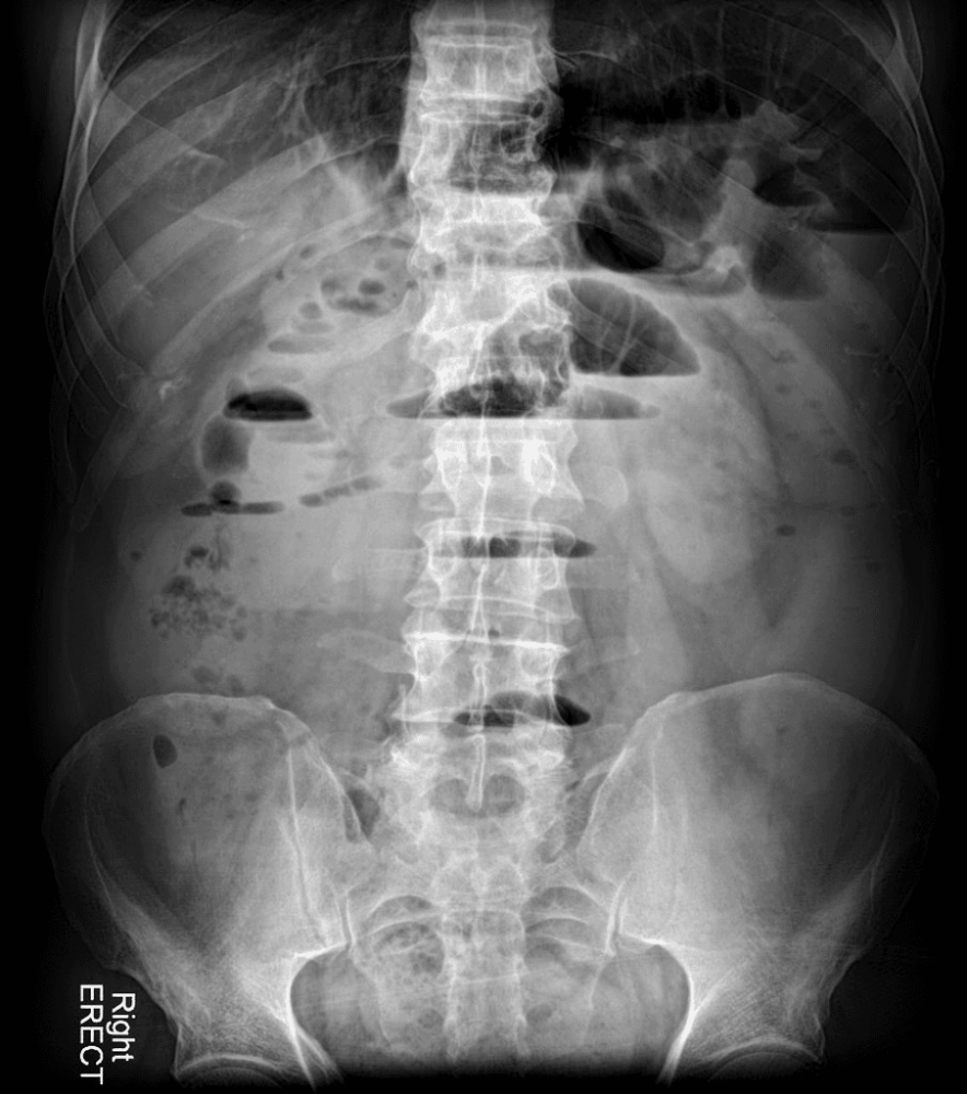 INTERPRETARE RADIOGRAFIE ABDOMINALA - INCURCATURA DE MATE