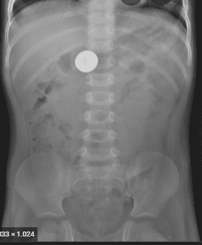 INTERPRETARE RADIOGRAFIE ABDOMINALA - MONEDA