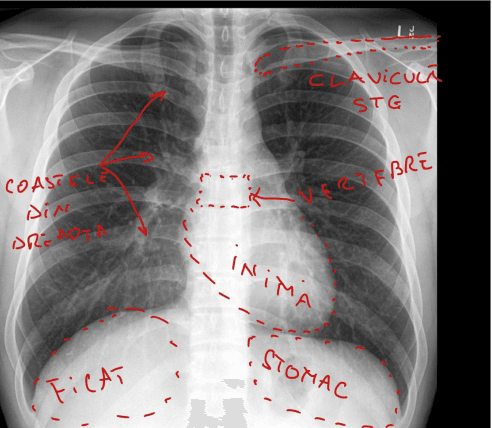 INTERPRETARE RADIOGRAFIE PULMONARA