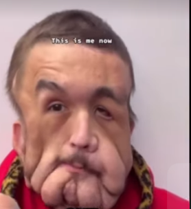 NEUROFIBROMATOZA