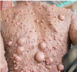 NEUROFIBROMATOZA