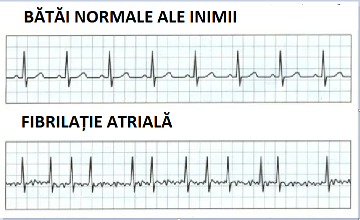 DESPRE FIBRILATIE ATRIALA