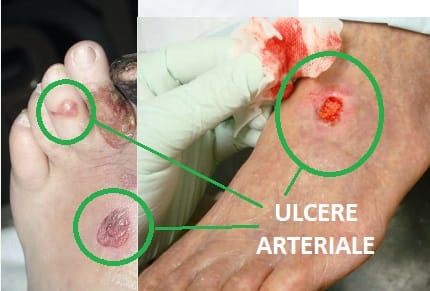 POZA ULCER ARTERIAL