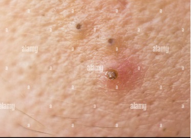 TEROAREA PUBERTĂȚII (II) – CE SUNT COSURILE