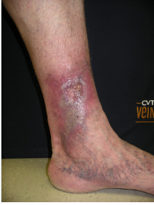 ULCER LA PICIOR