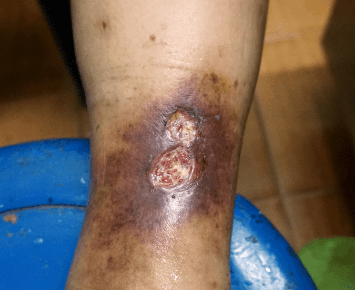 poza ulcer varicos