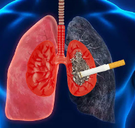 CUM APARE UN CARCINOM SCUAMOS LA PLĂMÂNUL FUMĂCIOS