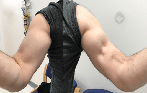 RUPTURA MUSCULARA BICEPS  