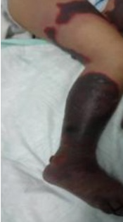 1/Z. CAZUL 22: IMOBILIZAREA FINALĂ