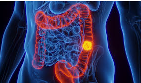 CANCERUL COLO RECTAL