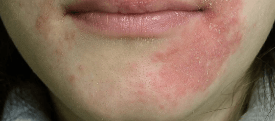 dermatita periorală