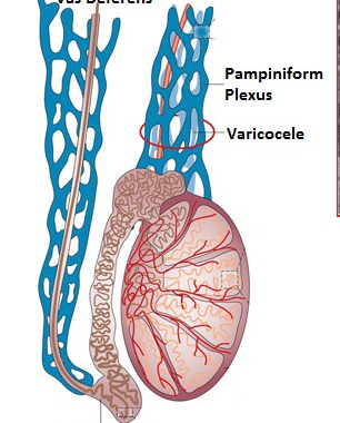 CE ESTE VARICOCELUL, SAU DACĂ E VORBA DE OUĂ …
