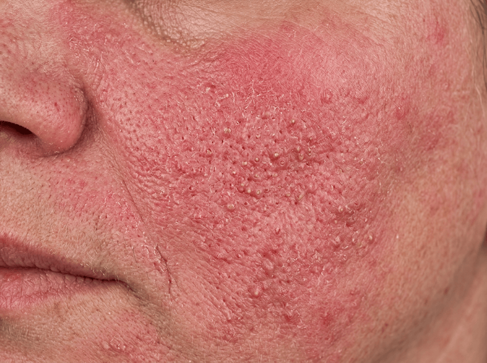 Fotografie clinica dermatologica macro cu demodecicoza cutanata pe fata prezentand eritem descuamare si pori dilatati.